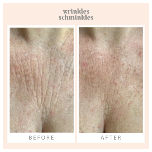 Wrinkles Schminkles Chest Smoothing Kit + Free Post