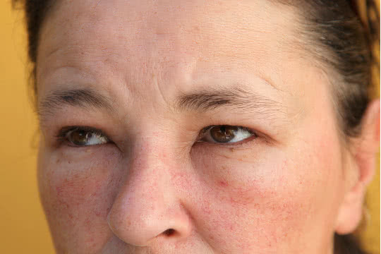 How Do I Know If I Have Rosacea?