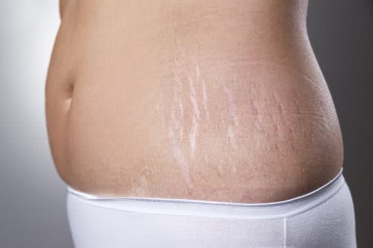bioderma stretch marks