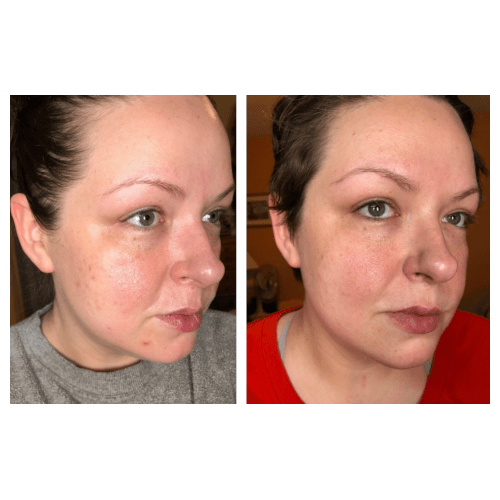 Trophy Skin RejuvaliteMD Before and After Photos