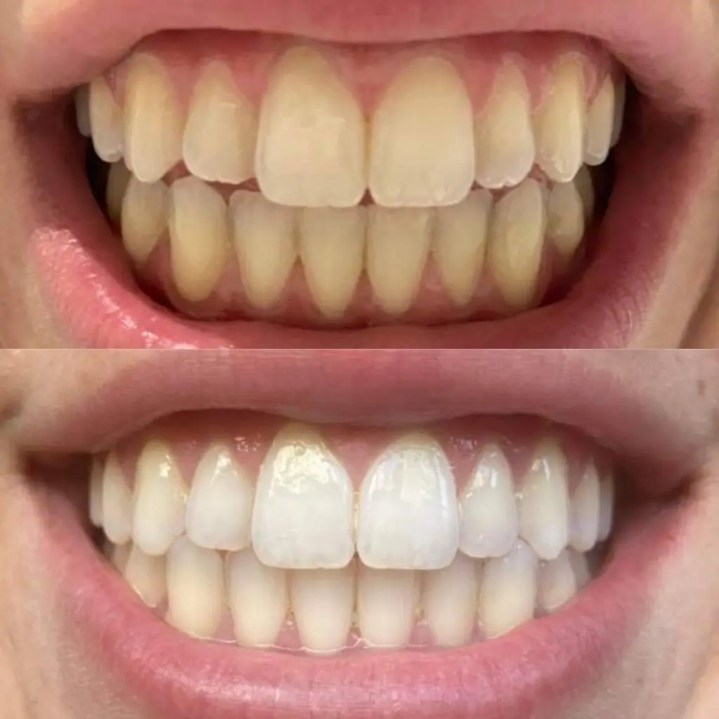 Gem Whitening Pen