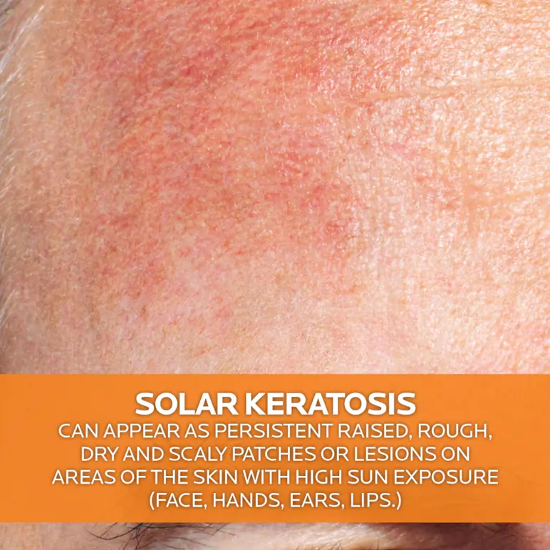 La Roche-Posay Anthelios KA+ SPF 50+ 50ml