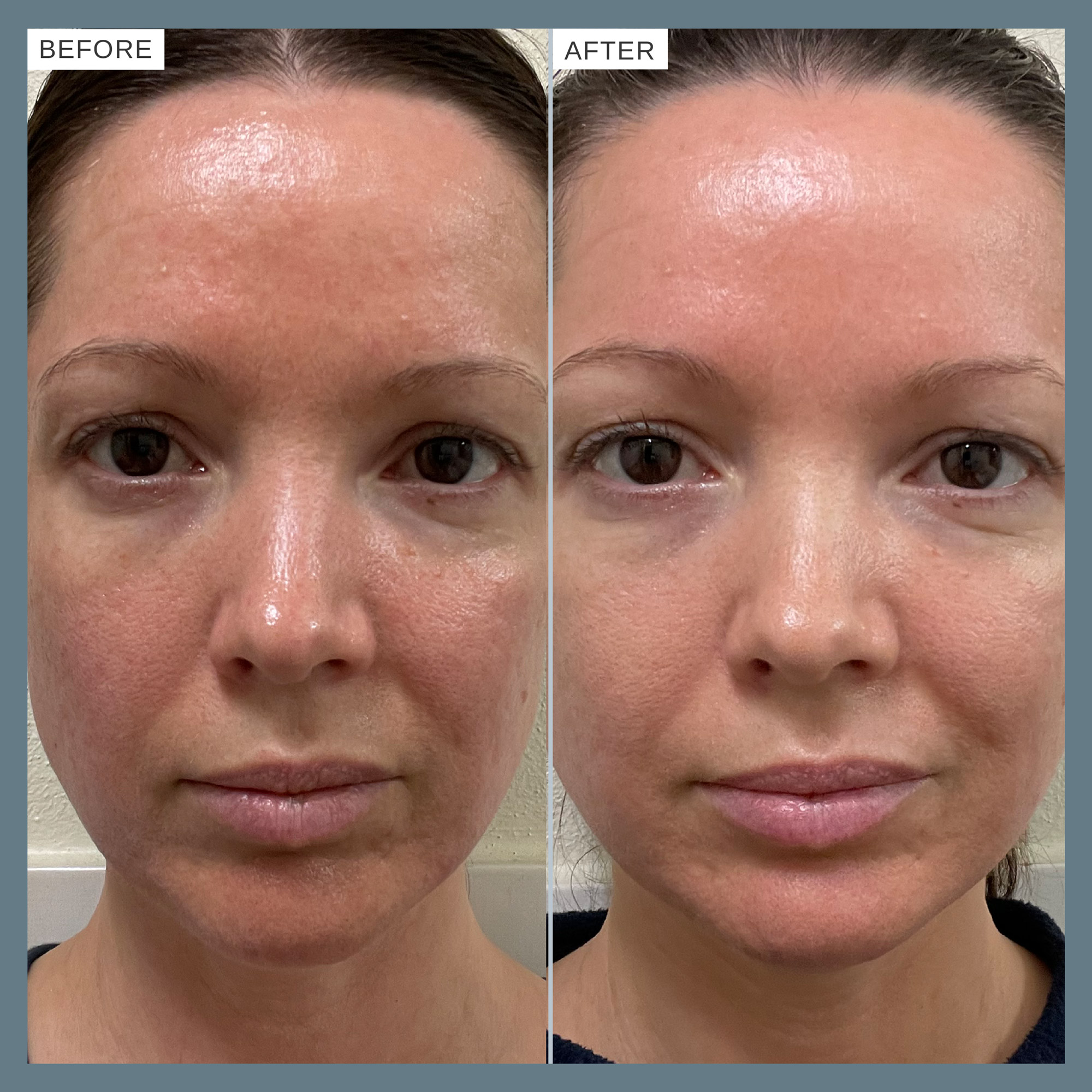 Alpha-H Vitamin B Serum with 0.5% Niacinamide 10ml